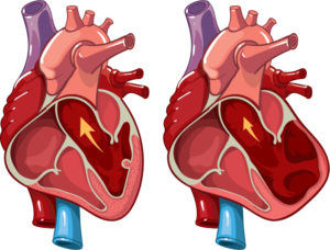 Herzfehler-Vorhof-erweitert-kardiomyopathie