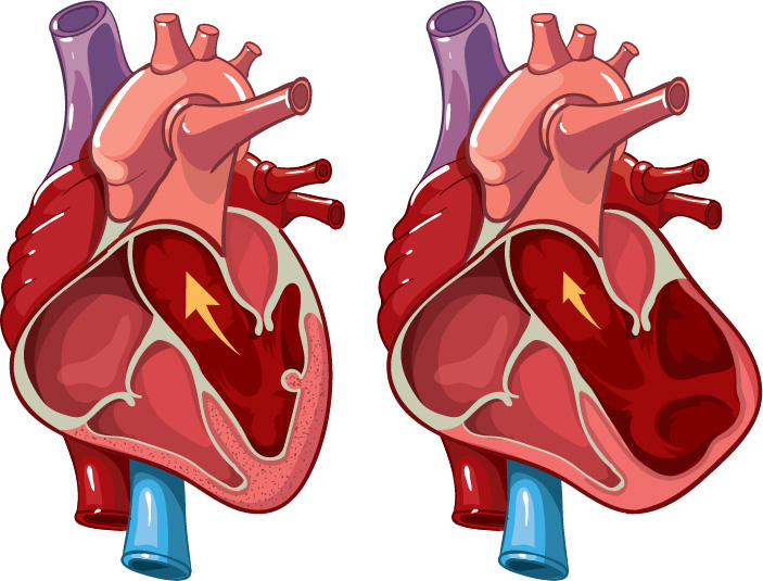 Herzfehler-Vorhof-erweitert-kardiomyopathie